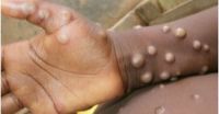 Monkeypox spreading worldwide: WHO convenes emergency meeting