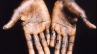 Monkeypox outbreak won't lead to another pandemic: WHO